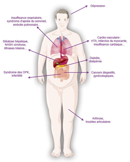 Les dangers de l'obésité pour la santé