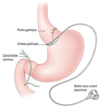 Schéma anneau gastrique